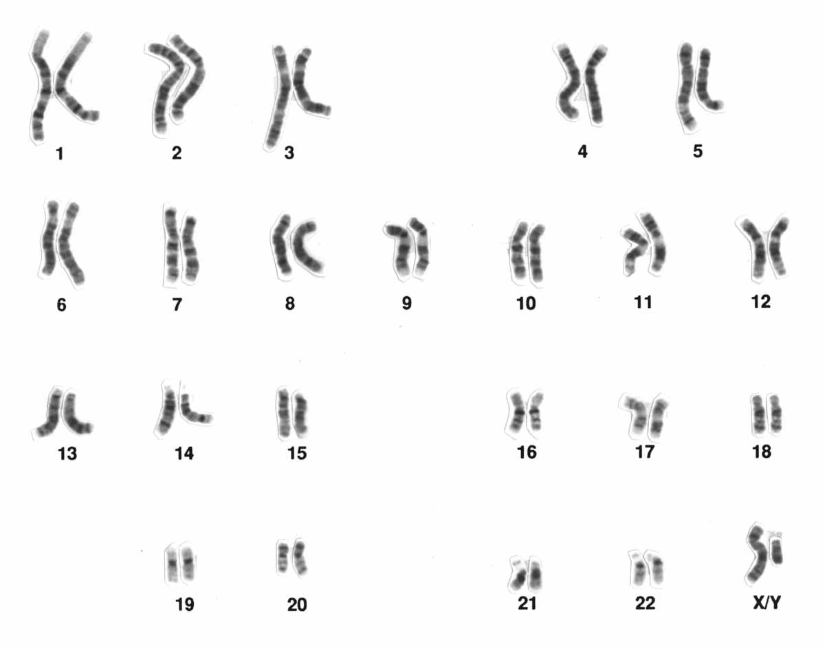 Bộ nhiễm sắc thể (karyotype) bình thường của người