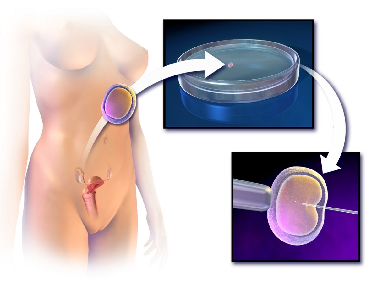 Minh họa quy trình thụ tinh trong ống nghiệm (IVF)