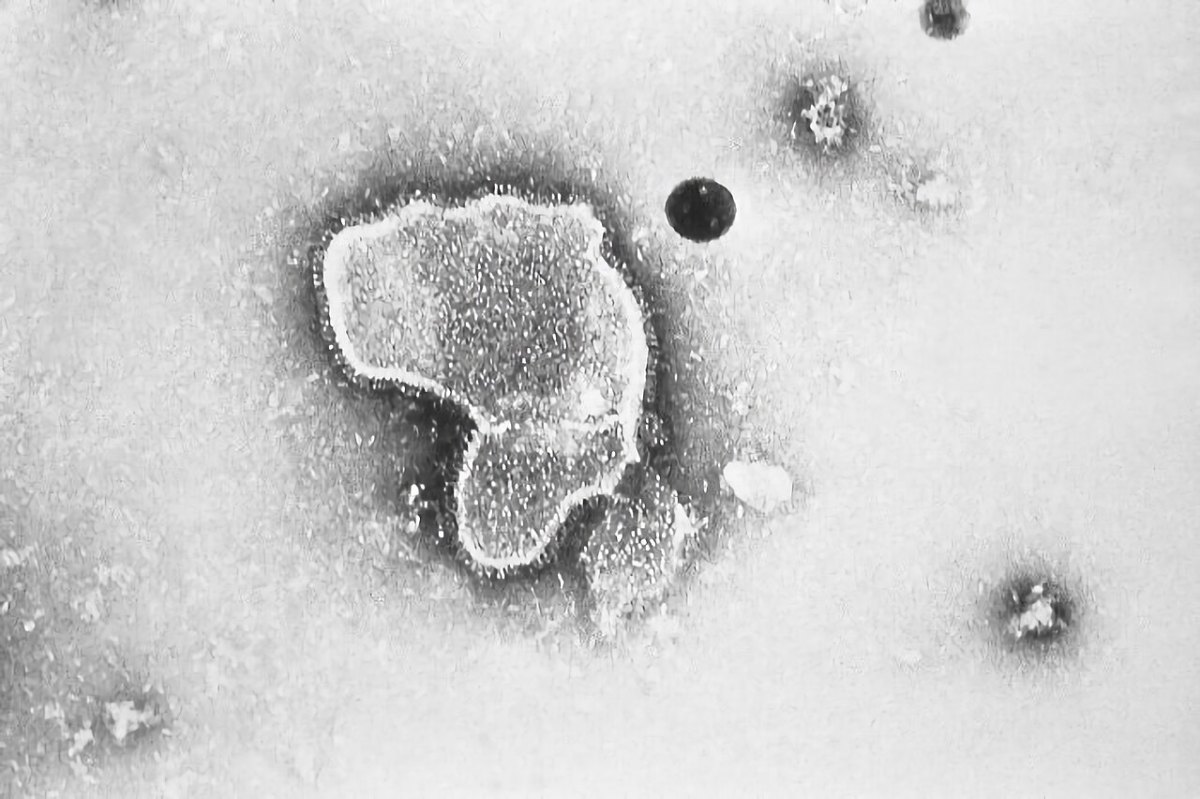 Virus hợp bào hô hấp (RSV) dưới kính hiển vi điện tử